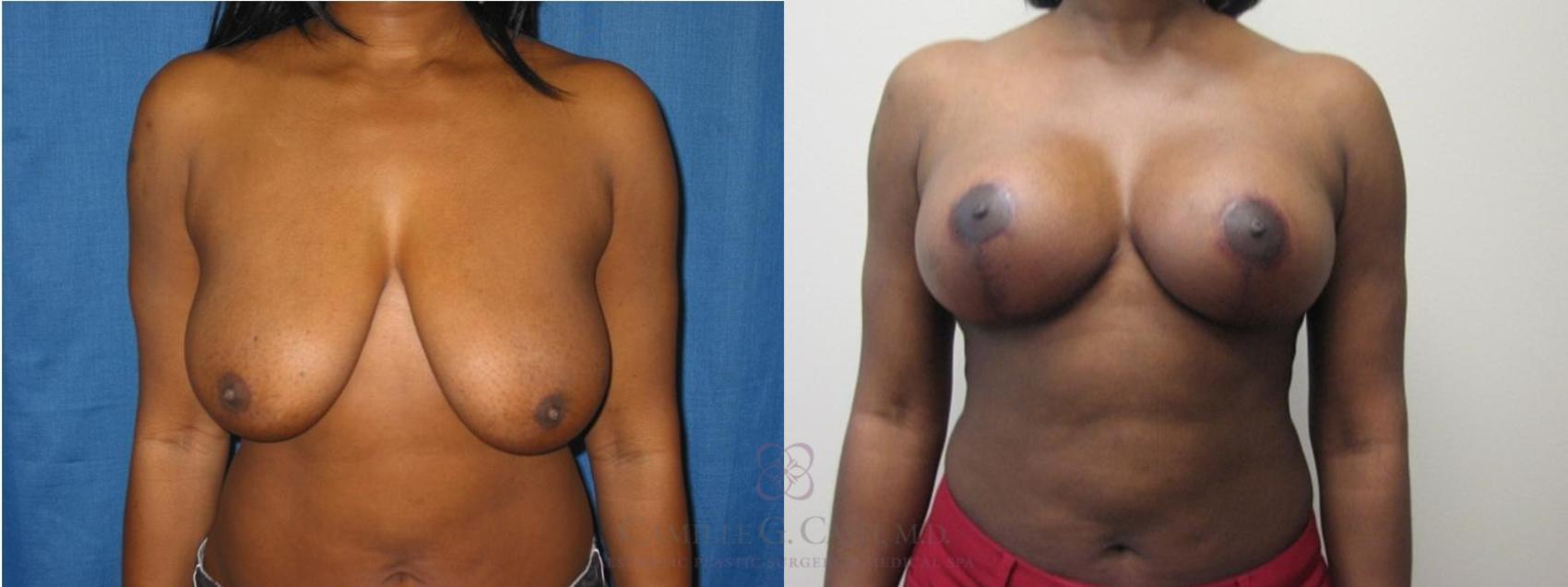 Before & After Breast Reduction Case 51 View #1 View in Houston, TX