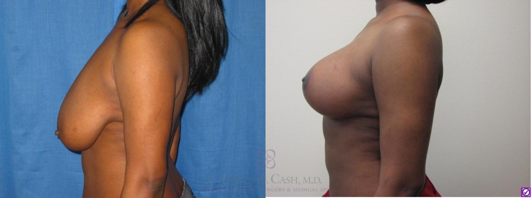 Before & After Breast Lift Case 51 View #2 View in Houston, TX