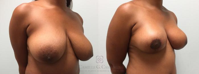 Before & After Breast Lift Case 513 Left Oblique View in Houston, TX
