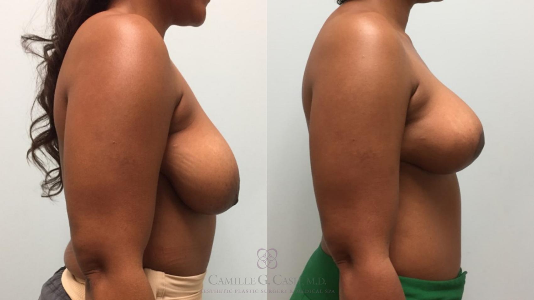 Before & After Breast Lift Case 513 Left Side View in Houston, TX