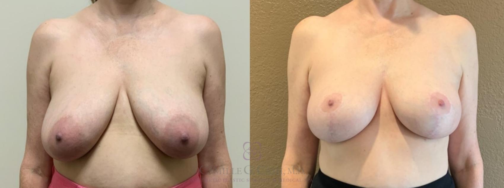 Before & After Breast Lift Case 531 Front View in Houston, TX