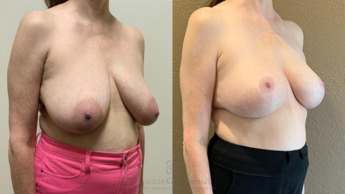 Before & After Breast Lift Case 531 Left Oblique View in Houston, TX
