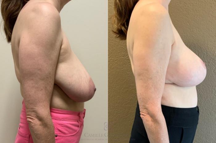 Before & After Breast Lift Case 531 Left Side View in Houston, TX