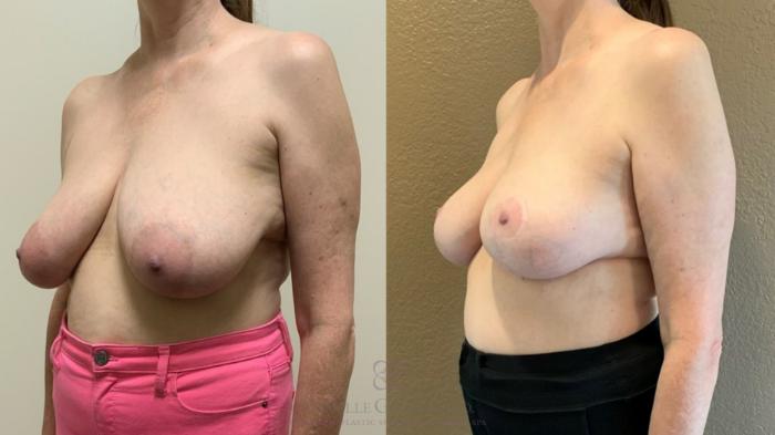 Before & After Breast Lift Case 531 Right Oblique View in Houston, TX