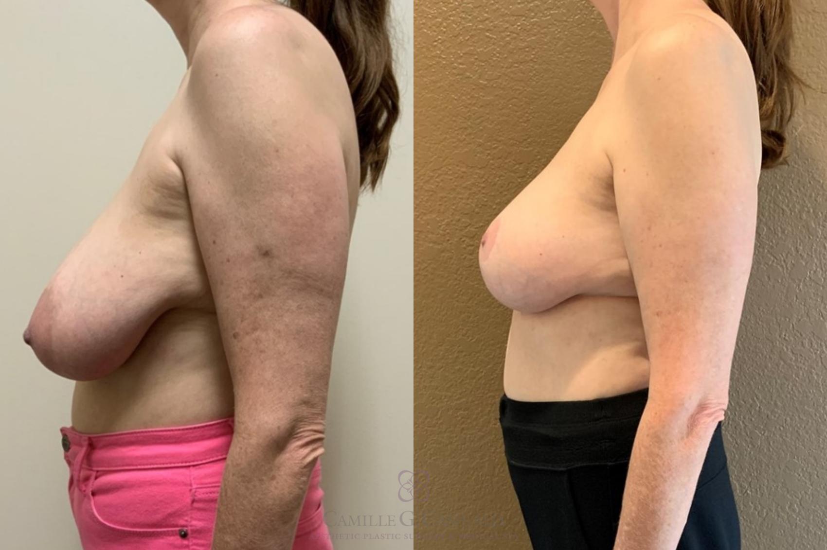 Before & After Breast Lift Case 531 Right Side View in Houston, TX