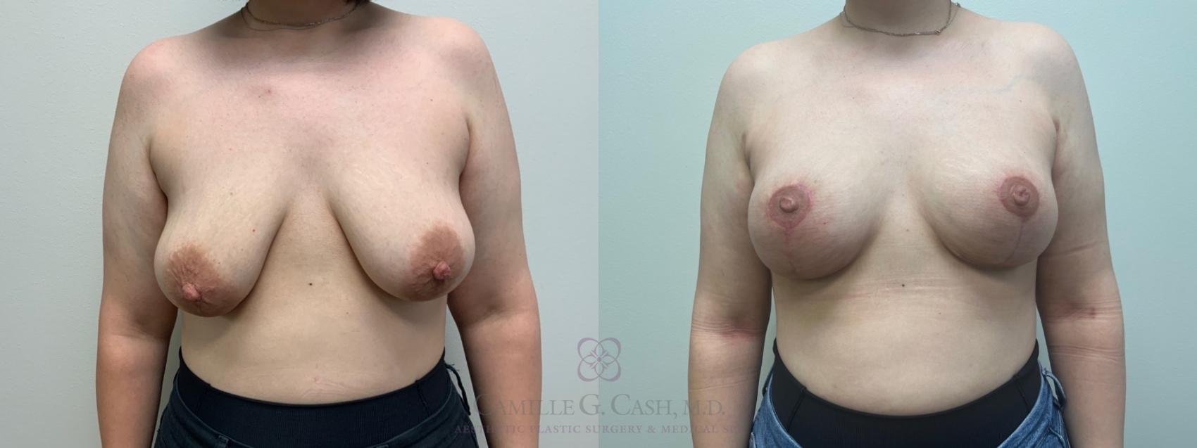 Before & After Breast Lift Case 546 front 2 View in Houston, TX