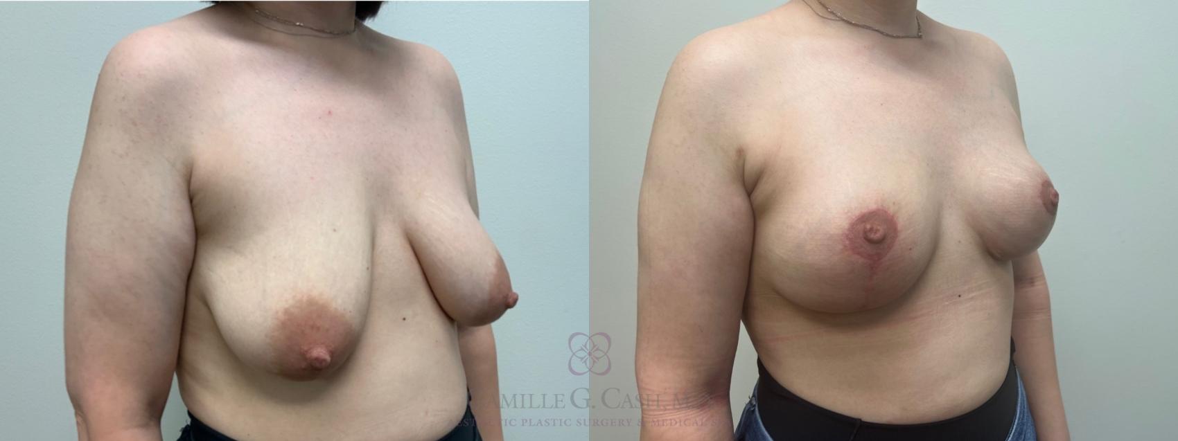 Before & After Breast Lift Case 546 Left Oblique View in Houston, TX