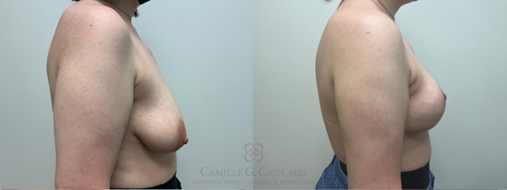 Before & After Breast Lift Case 546 Left Side View in Houston, TX