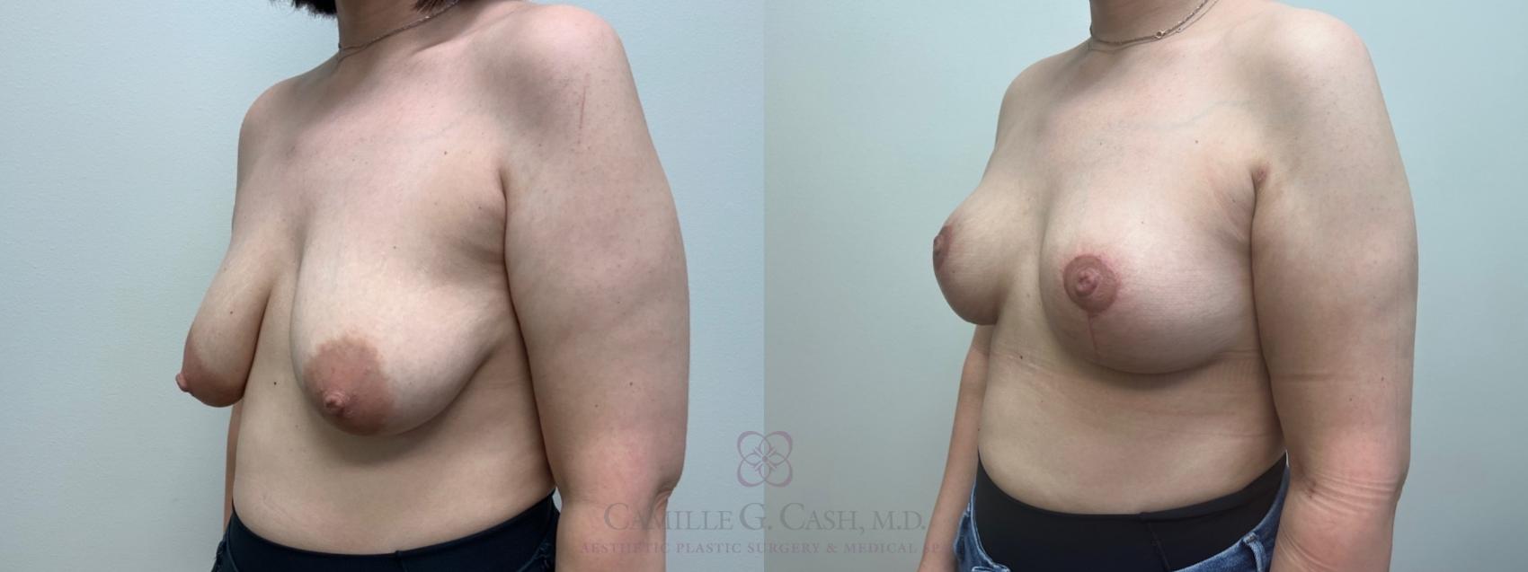 Before & After Breast Lift Case 546 Right Oblique View in Houston, TX