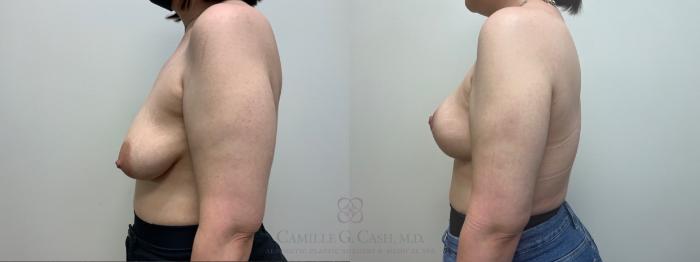 Before & After Breast Lift Case 546 Right Side View in Houston, TX