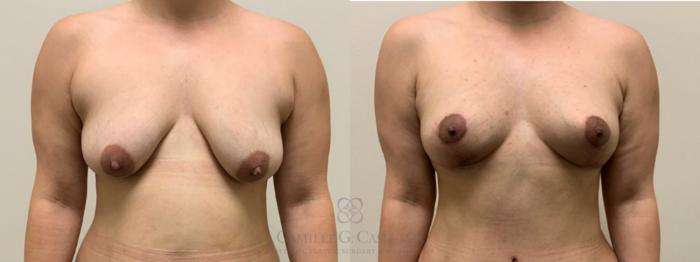 Before & After Breast Lift Case 549 Front View in Houston, TX