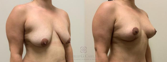 Before & After Breast Lift Case 549 Left Oblique View in Houston, TX