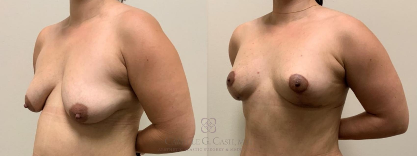 Before & After Breast Lift Case 549 Right Oblique View in Houston, TX