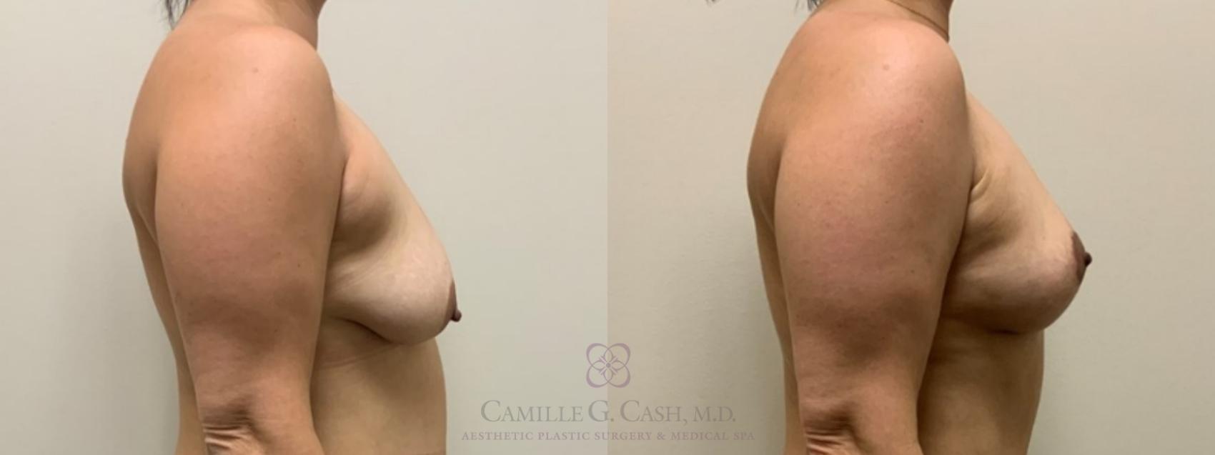 Before & After Breast Lift Case 549 Right Side View in Houston, TX