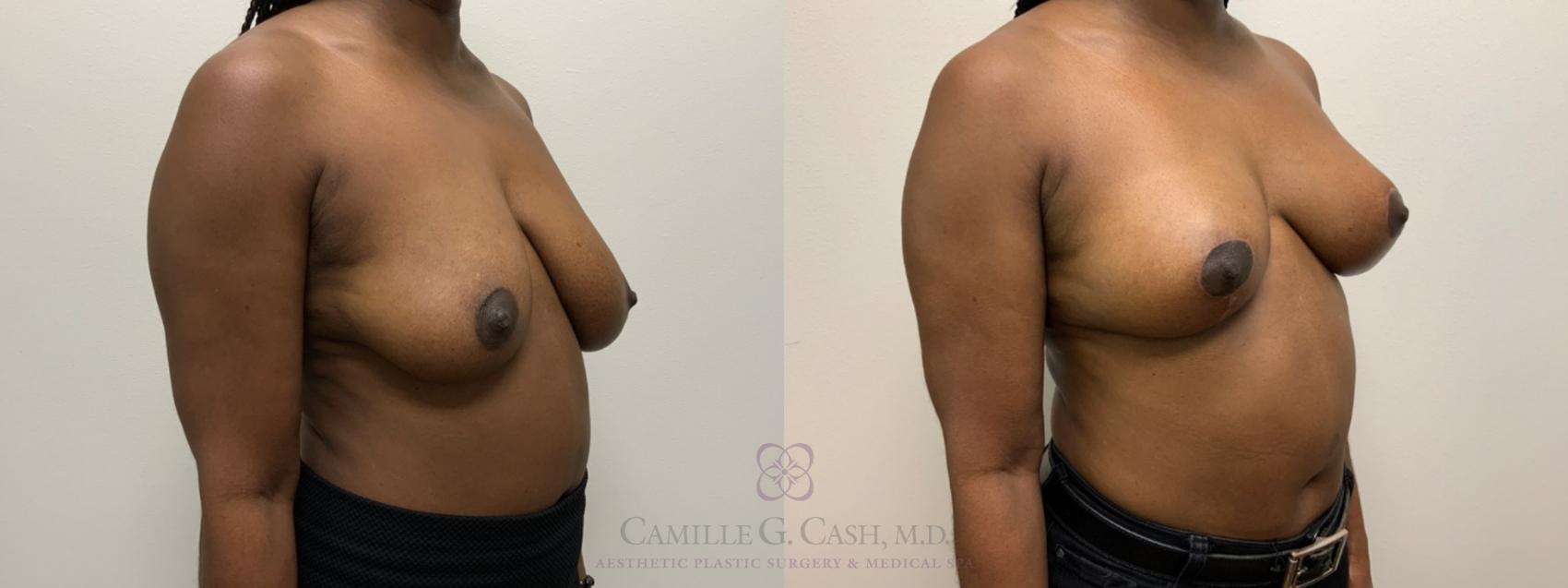 Before & After Breast Lift Case 564 Left Oblique View in Houston, TX