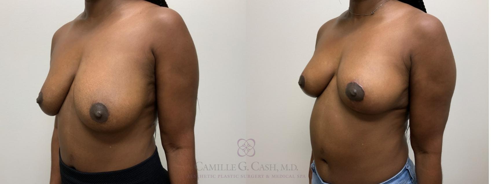 Before & After Breast Lift Case 564 right oblique 12 weeks View in Houston, TX