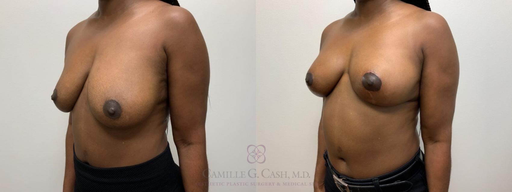 Before & After Breast Lift Case 564 Right Oblique View in Houston, TX