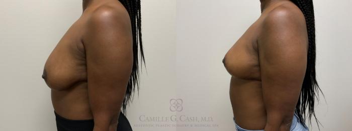 Before & After Breast Lift Case 564 Right Side View in Houston, TX