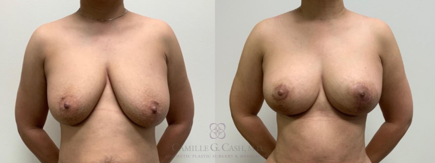 Before & After Breast Lift Case 595 Front View in Houston, TX