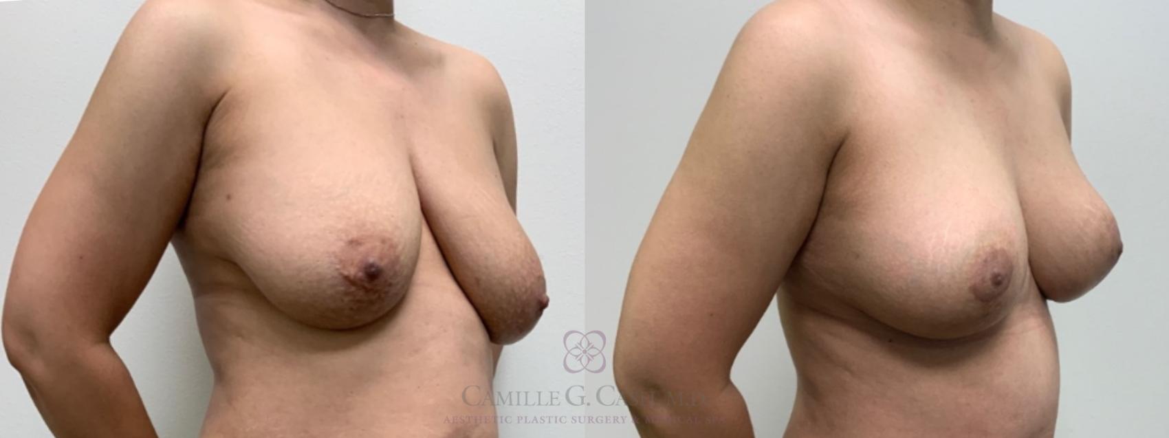 Before & After Breast Lift Case 595 Left Oblique View in Houston, TX