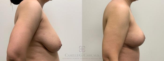 Before & After Breast Lift Case 595 Left Side View in Houston, TX