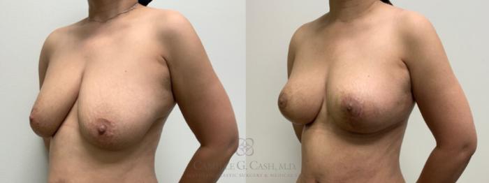 Before & After Breast Lift Case 595 Right Oblique View in Houston, TX