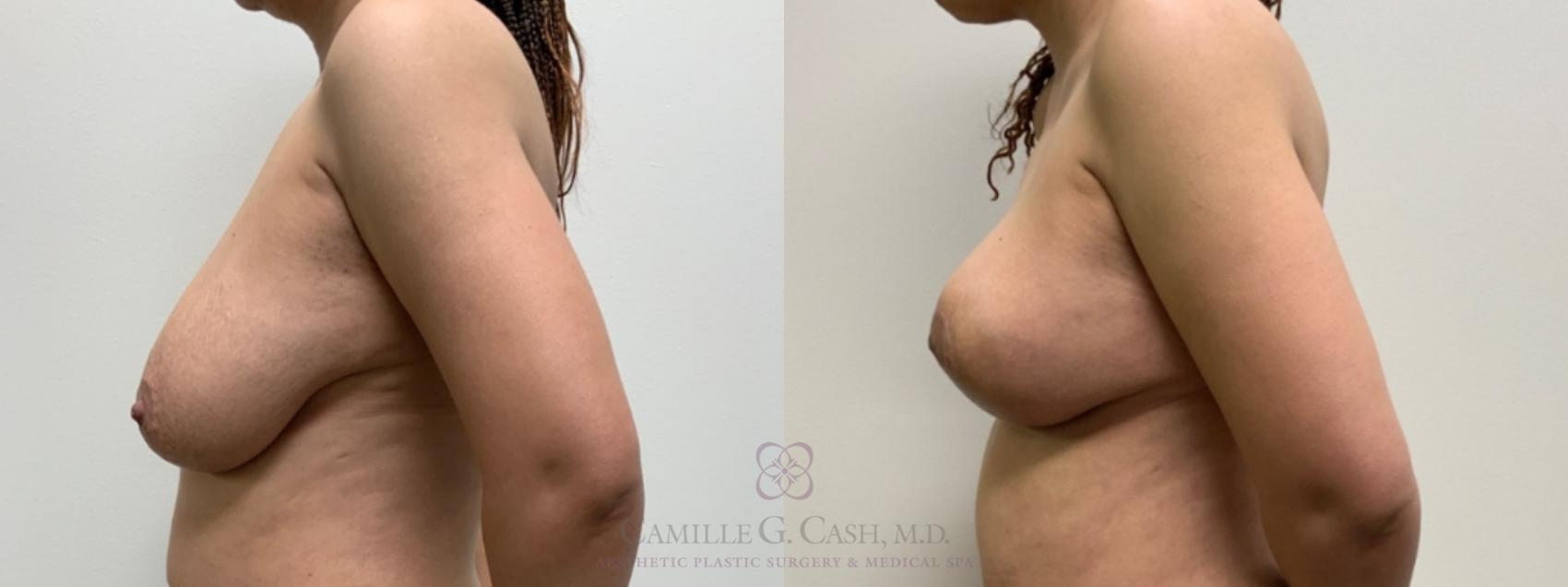 Before & After Breast Lift Case 595 Right Side View in Houston, TX