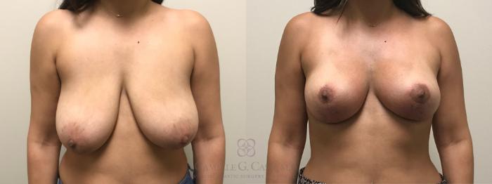 Before & After Breast Lift Case 620 Front View in Houston, TX