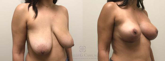 Before & After Breast Lift Case 620 Right Oblique View in Houston, TX