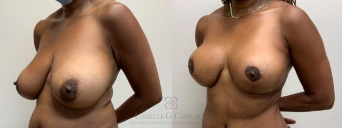 Before & After Breast Reduction Case 624 Left Oblique View in Houston, TX