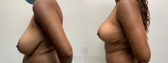 Before & After Breast Lift Case 624 Left Side View in Houston, TX