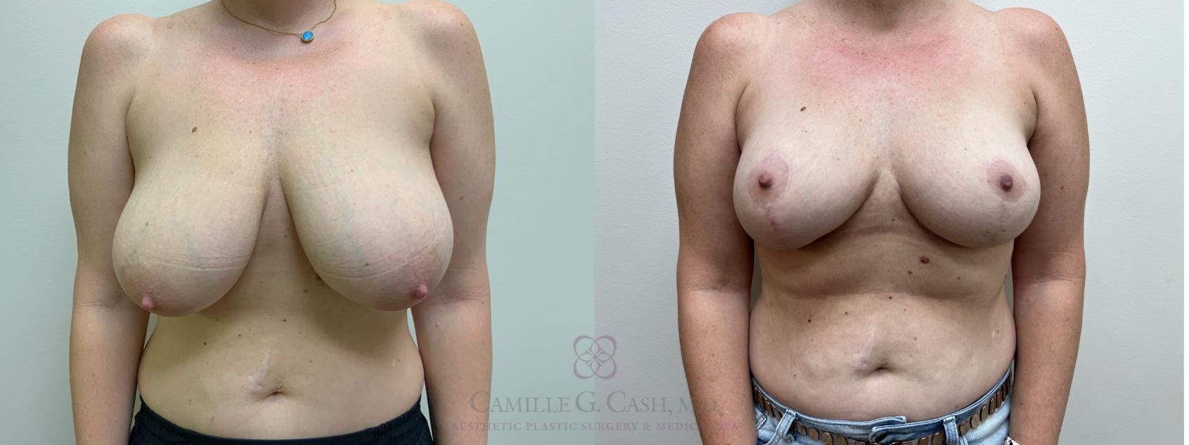 Before & After Breast Reduction Case 626 front 1 year after View in Houston, TX