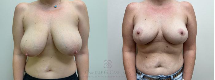 Before & After Breast Lift Case 626 front 1 year after View in Houston, TX