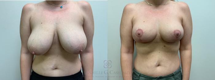 Before & After Breast Lift Case 626 Front View in Houston, TX