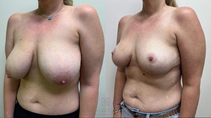 Before & After Breast Reduction Case 626 left oblique 1 year View in Houston, TX