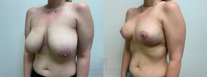 Before & After Breast Lift Case 626 Left Oblique View in Houston, TX