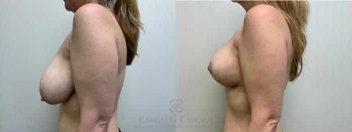 Before & After Breast Reduction Case 626 Left Side View in Houston, TX