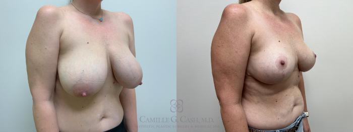 Before & After Breast Lift Case 626 right oblique View in Houston, TX