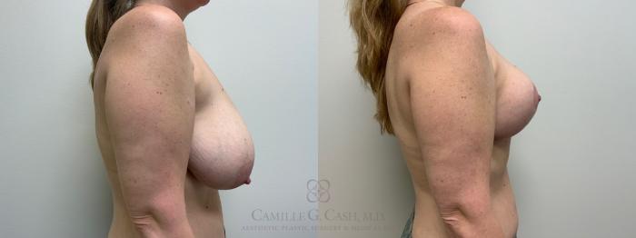 Before & After Breast Reduction Case 626 Right Side View in Houston, TX