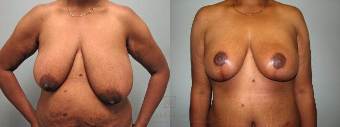 Before & After Post-Weight Loss Breast Enhancement Case 646 Front View in Houston, TX