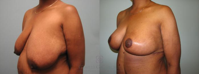 Before & After Breast Lift Case 646 Left Oblique View in Houston, TX
