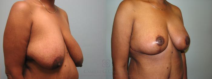 Before & After Breast Lift Case 646 Right Oblique View in Houston, TX