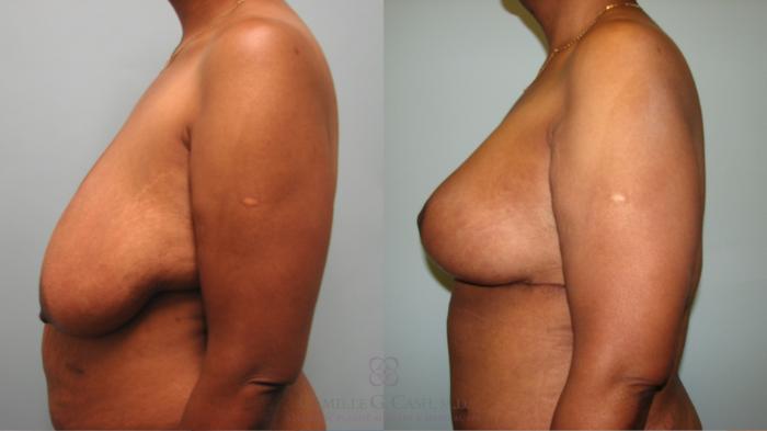 Before & After Breast Lift Case 646 Right Side View in Houston, TX