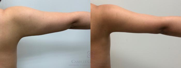 Before & After Breast Lift Case 654 Back View in Houston, TX