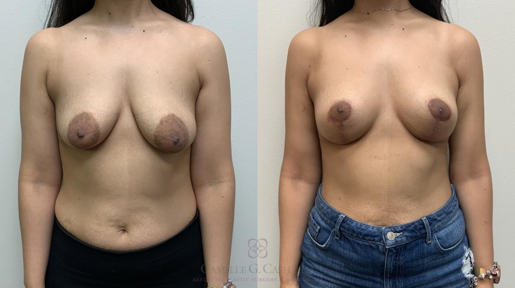 Before & After Breast Lift Case 654 Front View in Houston, TX