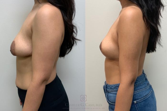 Before & After Breast Lift Case 654 Left Side View in Houston, TX