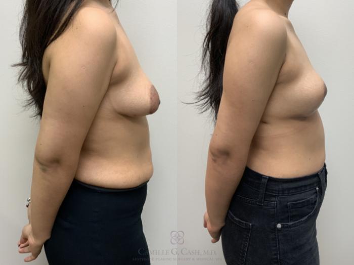 Before & After Breast Lift Case 654 Right Side View in Houston, TX