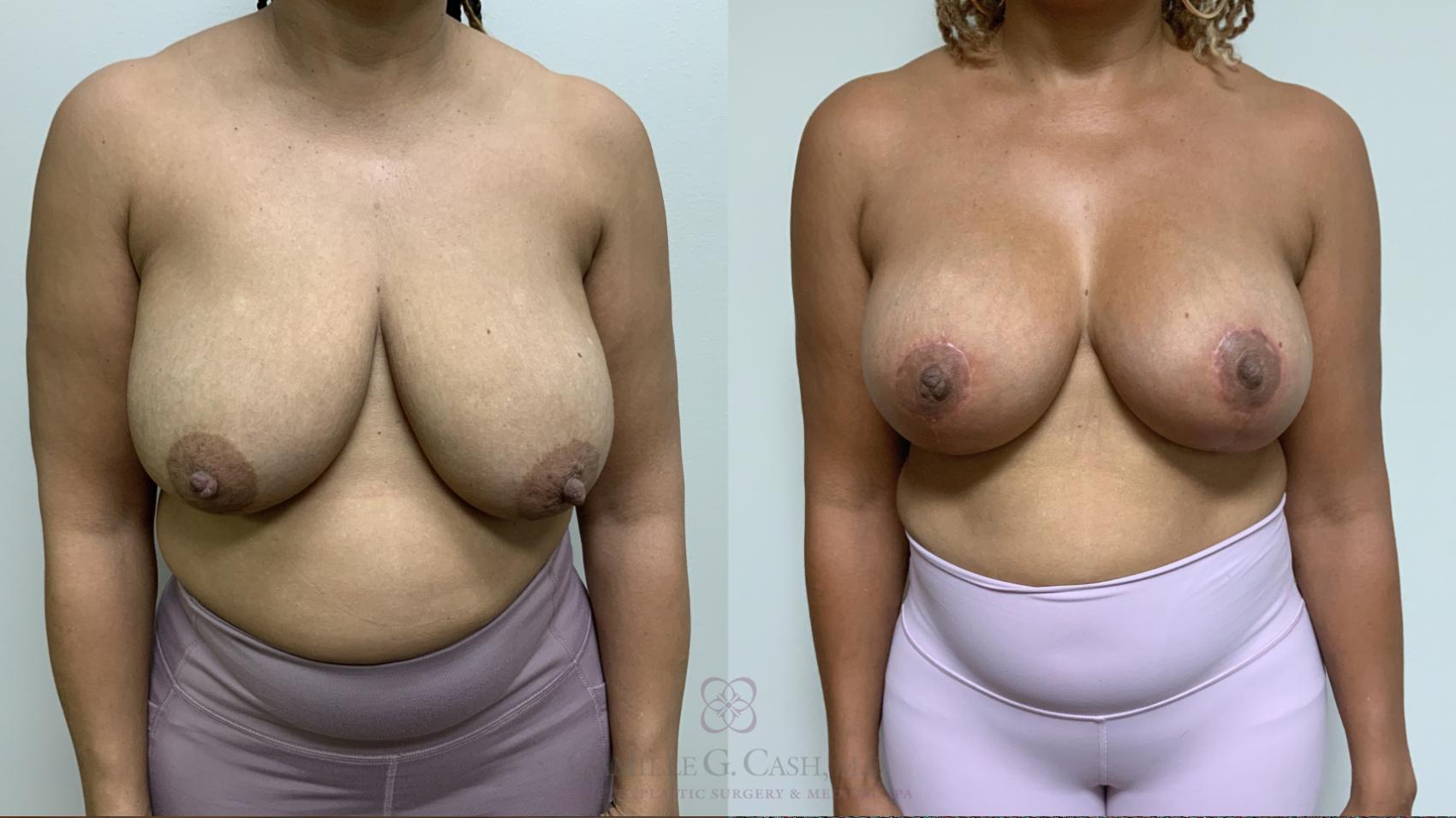 Before & After Breast Lift Case 658 Front View in Houston, TX