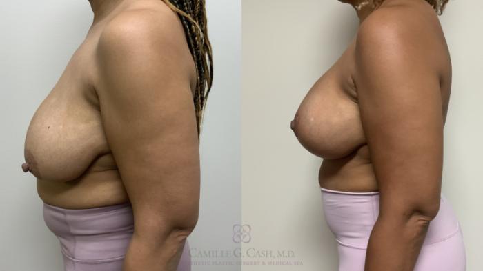 Before & After Breast Lift Case 658 Left Side View in Houston, TX