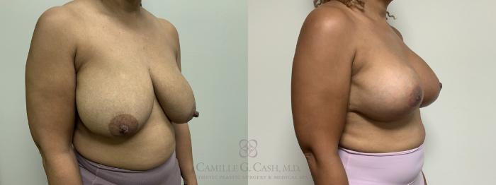 Before & After Breast Lift Case 658 Right Oblique View in Houston, TX